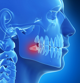 impacted wisdom tooth horizontal